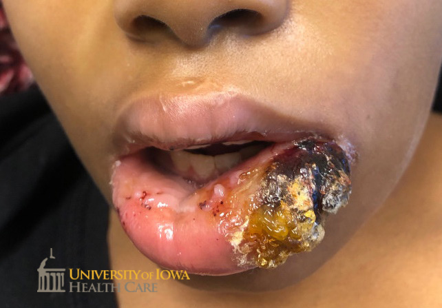 Hemorrhagic, thick, yellow crusted plaque on the lower lip. (click images for higher resolution).